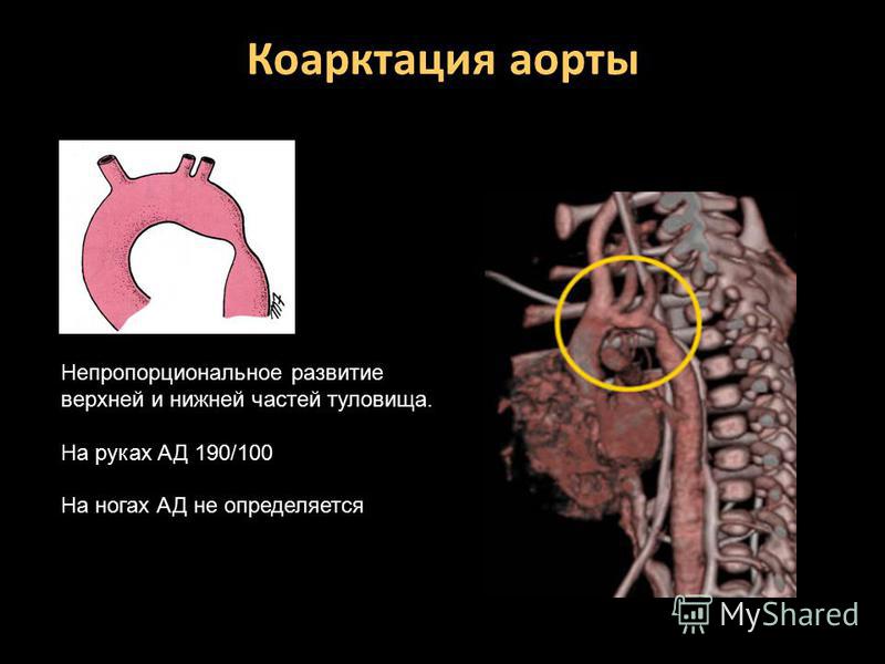 Коарктация аорты картинки