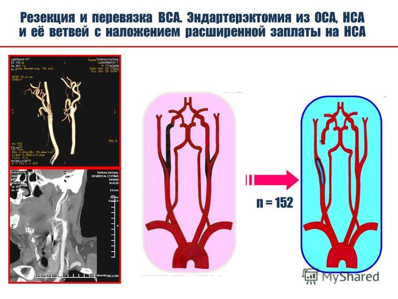 Правая внутренняя сонная артерия