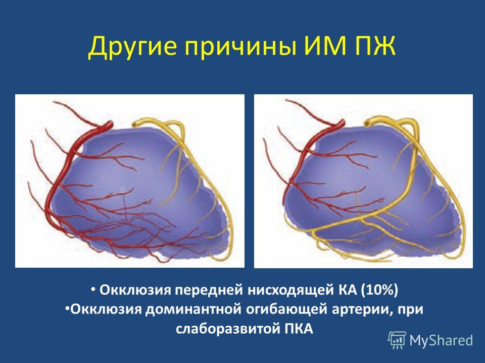 Коронарная окклюзия. Окклюзия передней нисходящей артерии. Окклюзия огибающей артерии.