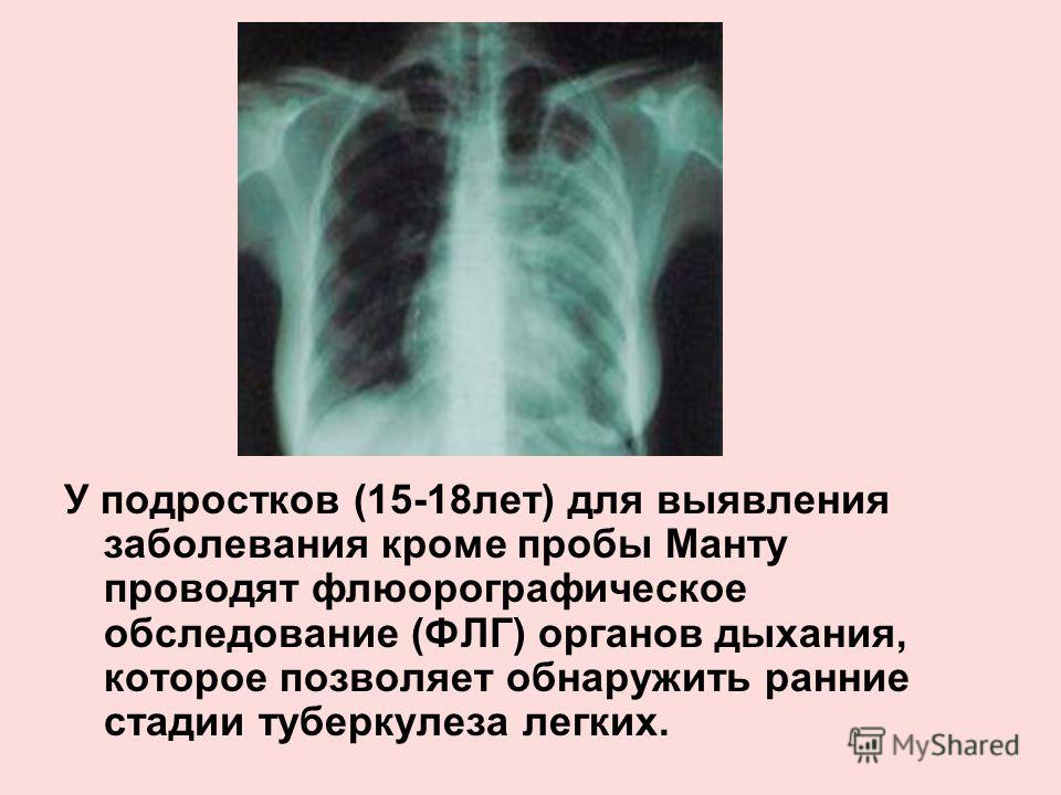 Исходы туберкулеза легких