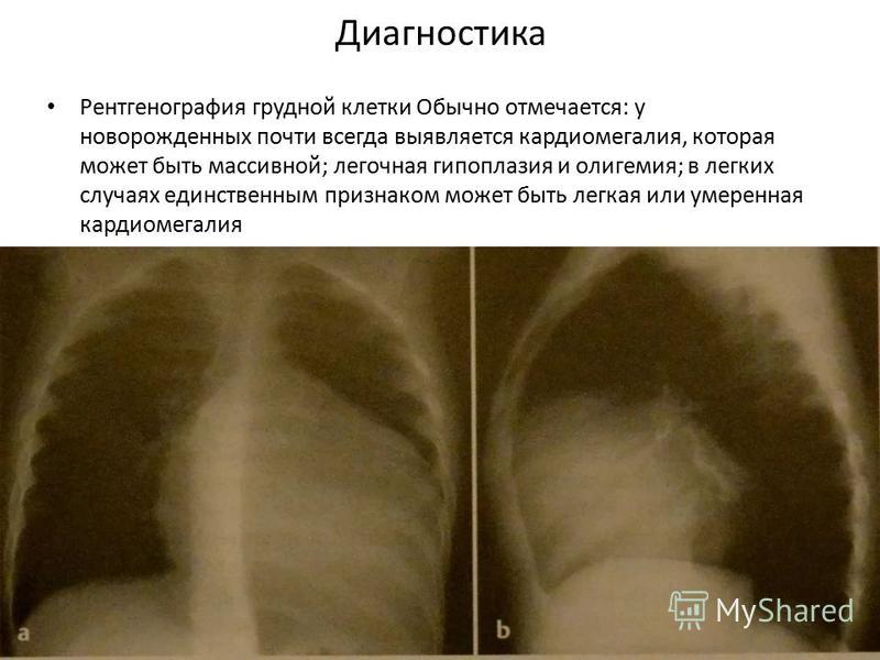 Рентген при аномалии Эбштейна. Сердце на рентгене грудной клетки. Пороки развития легких рентген. Гипоплазия правых синусов