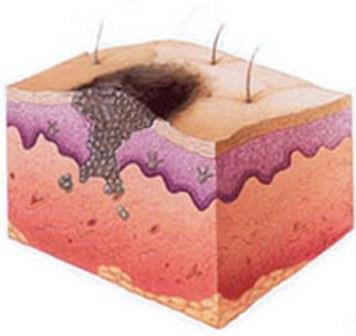 Прорастание меланомы внутрь кожных покровов и распространение метастазов
