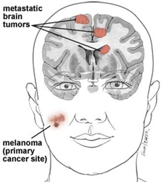 Метастазы в головном мозге – смертельное осложнение онкозаболевания