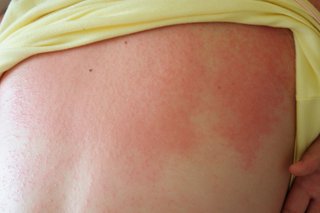 Heat rash on the back