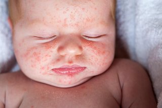 Red spotty rash on a baby