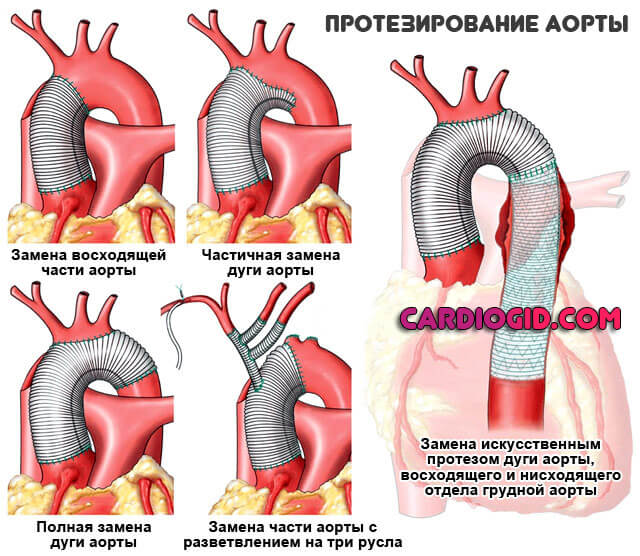 операции-при-аневризме-брюшной-аорты