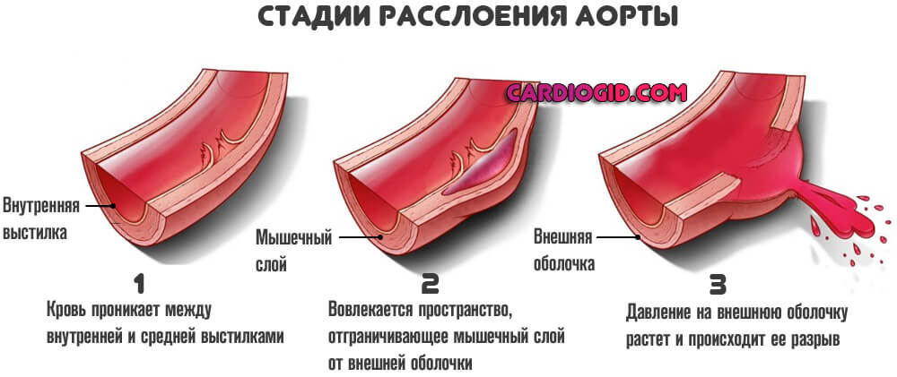 стадии-расслоения-аорты