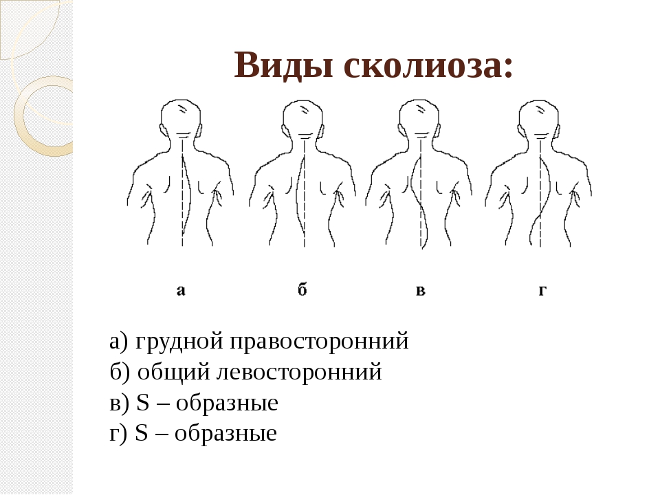 Все виды искривления позвоночника с картинками