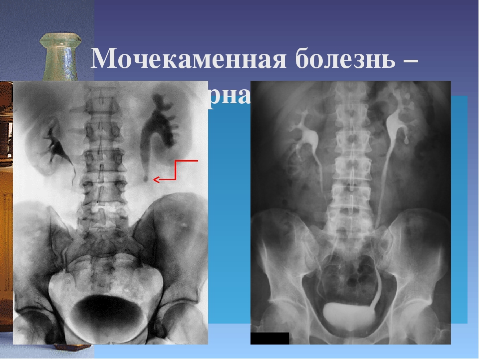 Экскреторная урография. Обзорная урография мочекаменная болезнь. Обзорная урограмма мочекаменная болезнь. Мочекаменная болезнь экскреторная урография. Экскреторная урография при мочекаменной болезни.