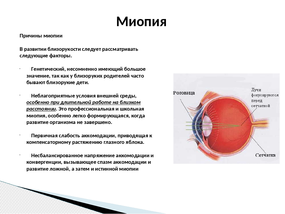 Зрение близорукость. Болезнь глаз миопия. Близорукость миопия. Причины близорукости. Близорукость развивается при.