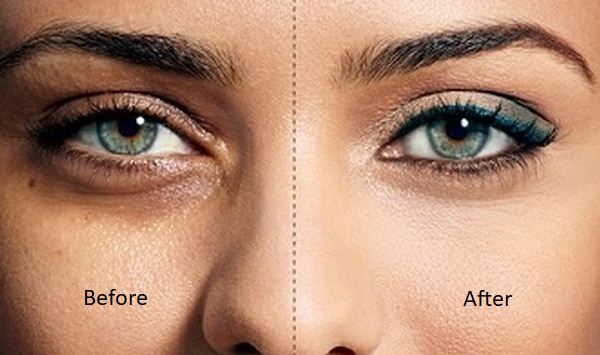 dark circles before after