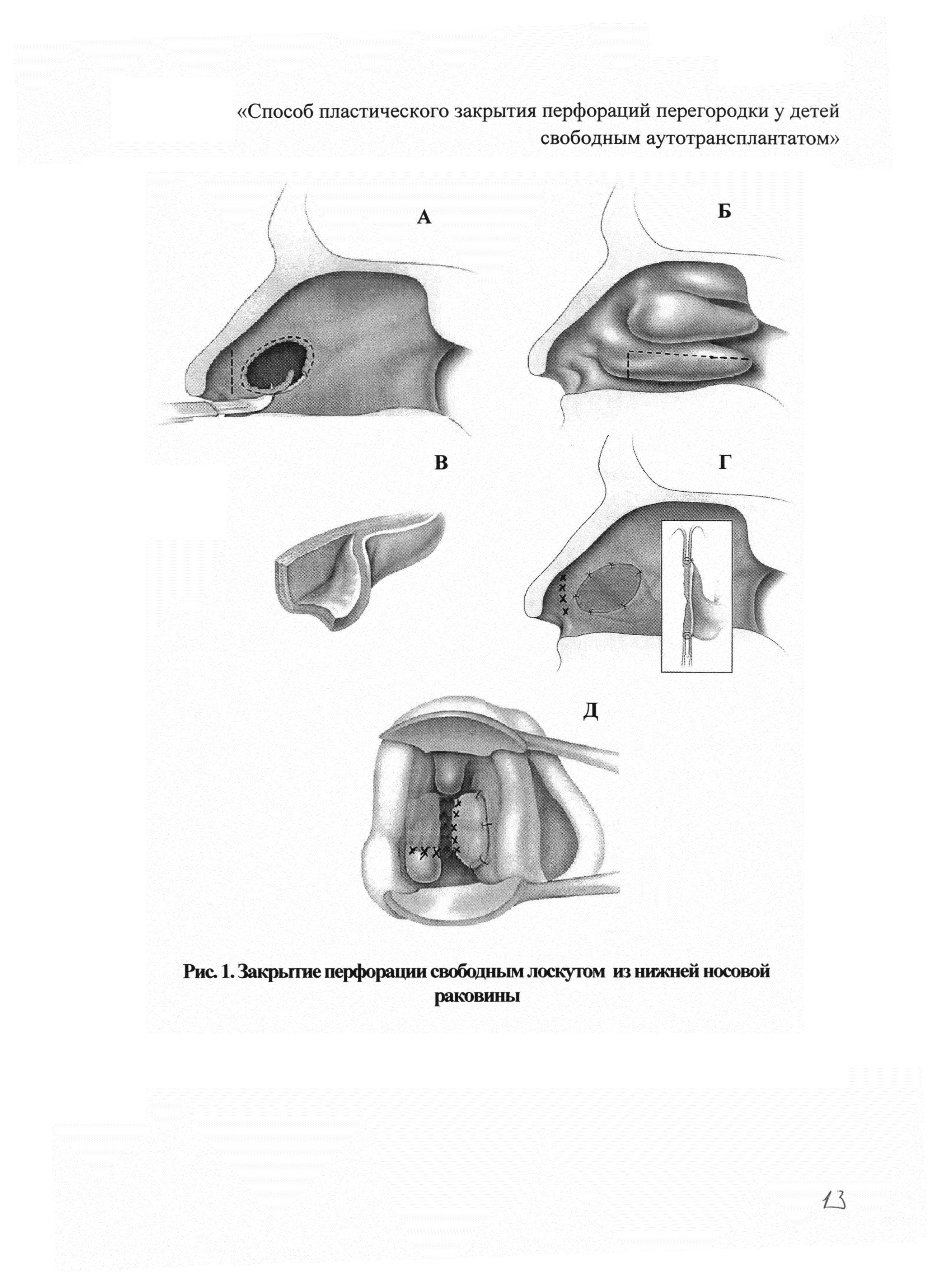 Перфорация носовой перегородки лечение. Перфорация носовой перегородки на кт. Искривление носовой перегородки риноскопия. Закрытие перфорации перегородки носа. Методы обследования при деформации носовой перегородки.