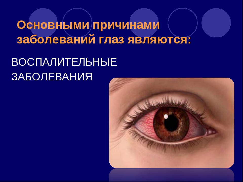 Общие заболевания глаза. Перечень заболеваний глаз. Воспалительные заболевания глаз. Заболевания глаз список. Заболевание глаз у человека список.
