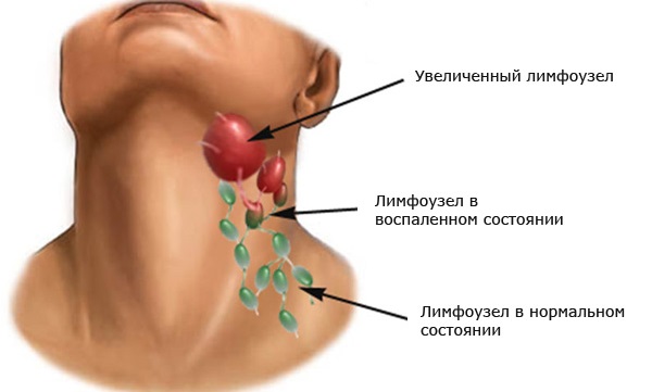Лимфатические узлы на теле человека. Описание, атлас-схема, за что отвечают, как лечить