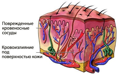 Синяки на ногах без причин у женщин. Почему появляются, лечение. К какому врачу обратиться