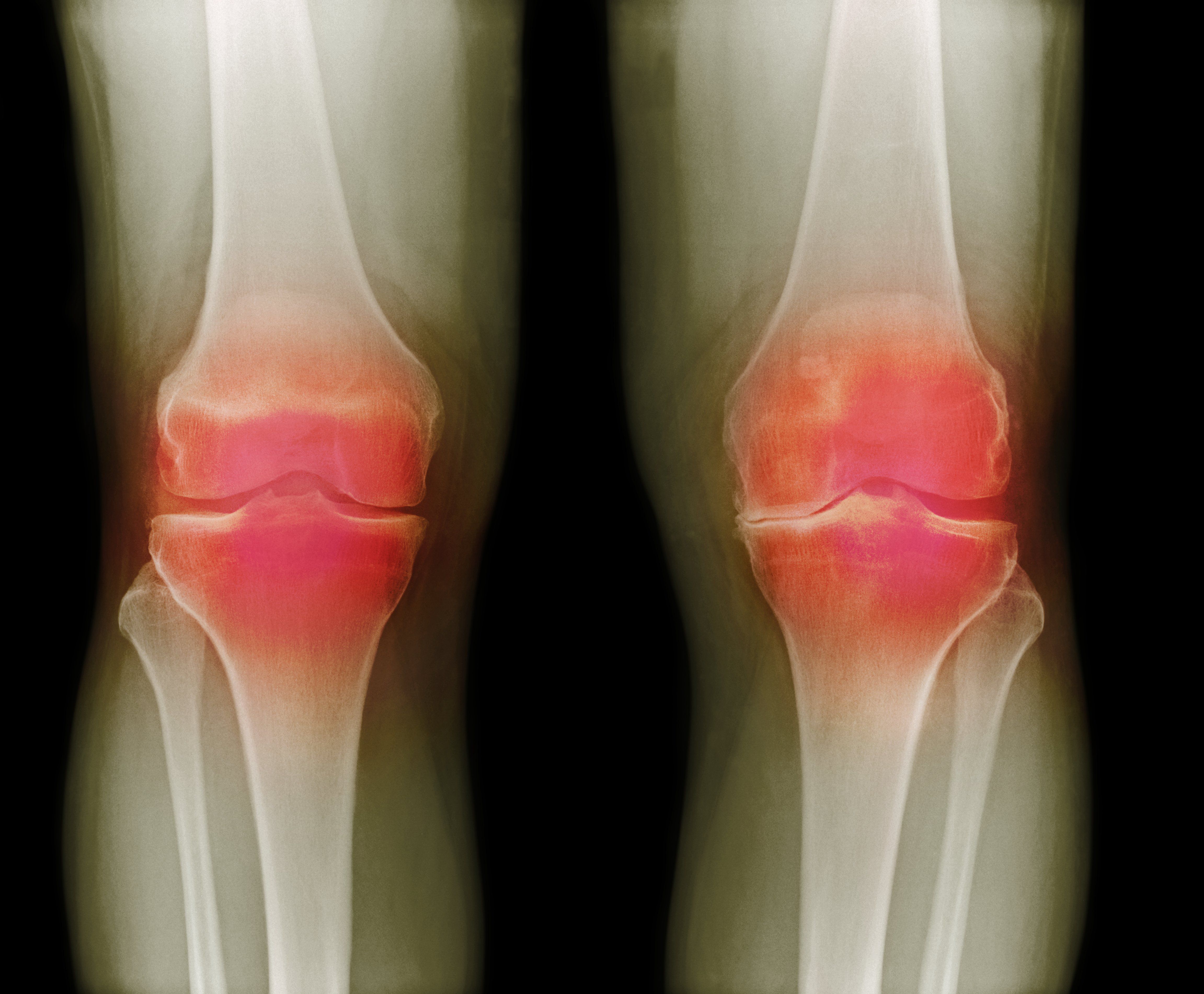 Болезнь суставов артрита. Ревматоидный артрит коленного сустава рентген. Лигаментоз крестовидных связок коленного сустава что это. Ревматический артрит коленного сустава. Подагра коленного сустава рентген.