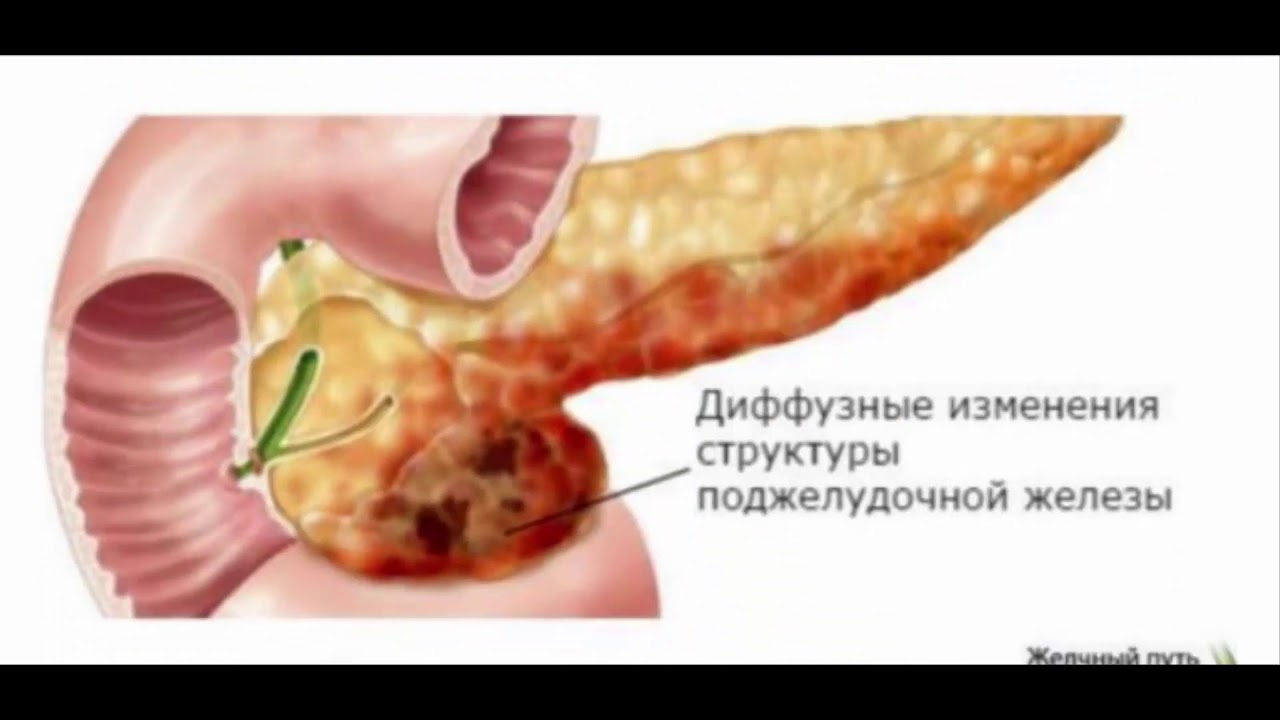 Поджелудочная железа диффузно повышена. Липоматоз поджелудочной железы. Липоматоз поджелудочной железы на УЗИ. Липоматоз и фиброз поджелудочной железы и печени. Жировое Перерождение поджелудочной железы.