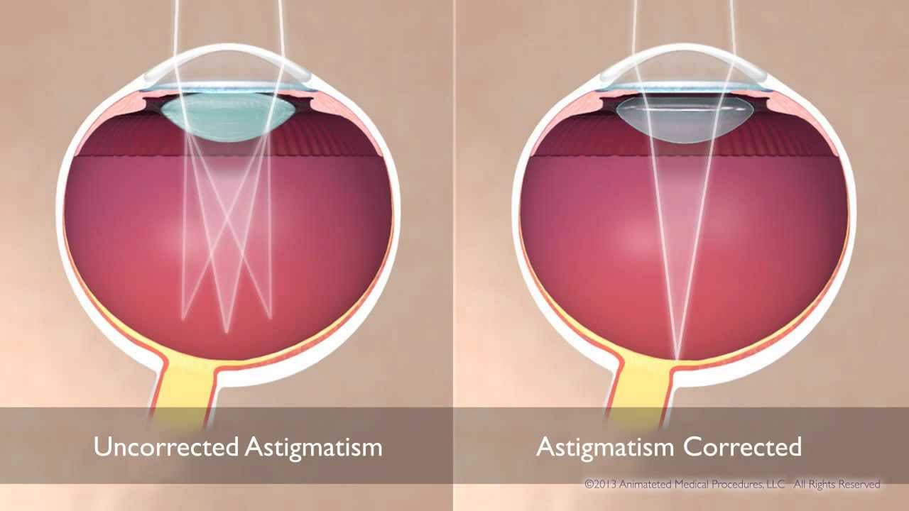 Астигматизм группа здоровья. Астигматизм. Капли при астигматизме. Астигматизм как видит глаз. Свет фар при астигматизме.