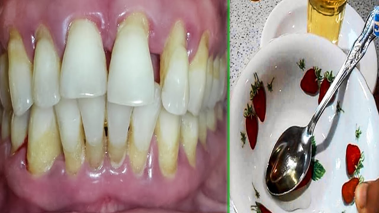 Лечение пародонтоза Томск Сплавной 4-й Удаление зубного камня Томск Смирнова
