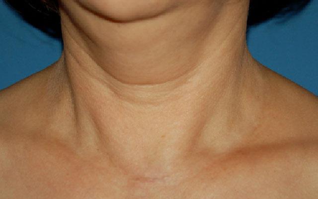 Отек после удаления щитовидной железы фото