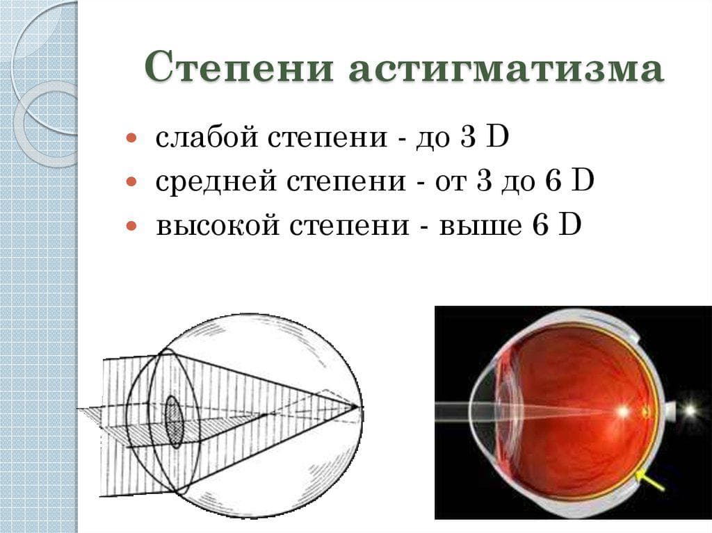 Сложный гиперметропический астигматизм глаз. Сложный прямой миопический астигматизм. Сложный миопический обратный астигматизм. Сложный милпический астигматищм 1 ст. Сложный гиперметропический астигматизм 1 степени.