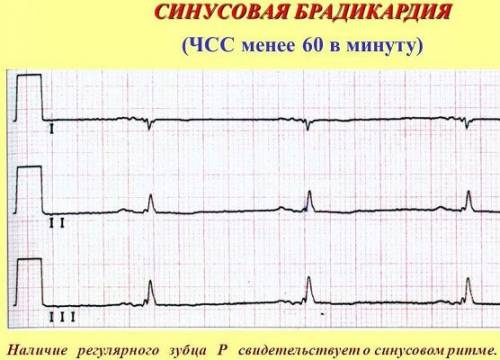 Брадикардия на кардиограмме