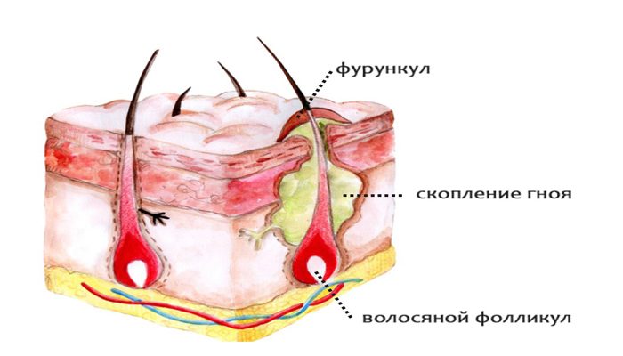 образование фурункула