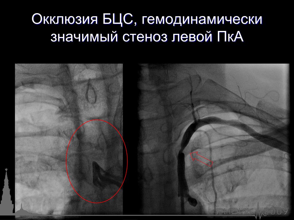 Стеноз общей сонной