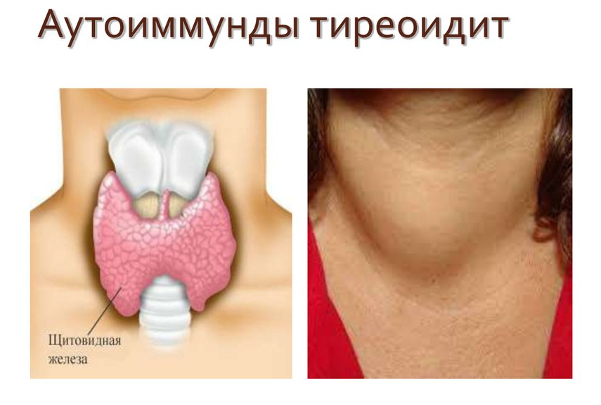 Аутоиммунный тиреоидит щитовидной железы что это такое