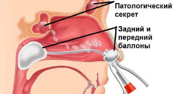 Ямик-процедура при гайморите