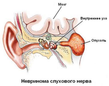 Невринома слухового нерва