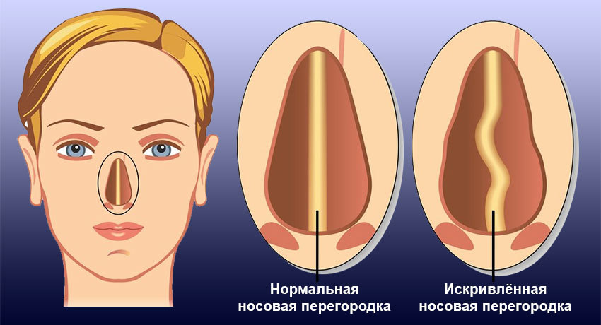 Носовая перегородка код по мкб 10. Анатомия искривлённой носовой перегородки. Имплозия носовой перегородки. Деформация носовой перегородки.