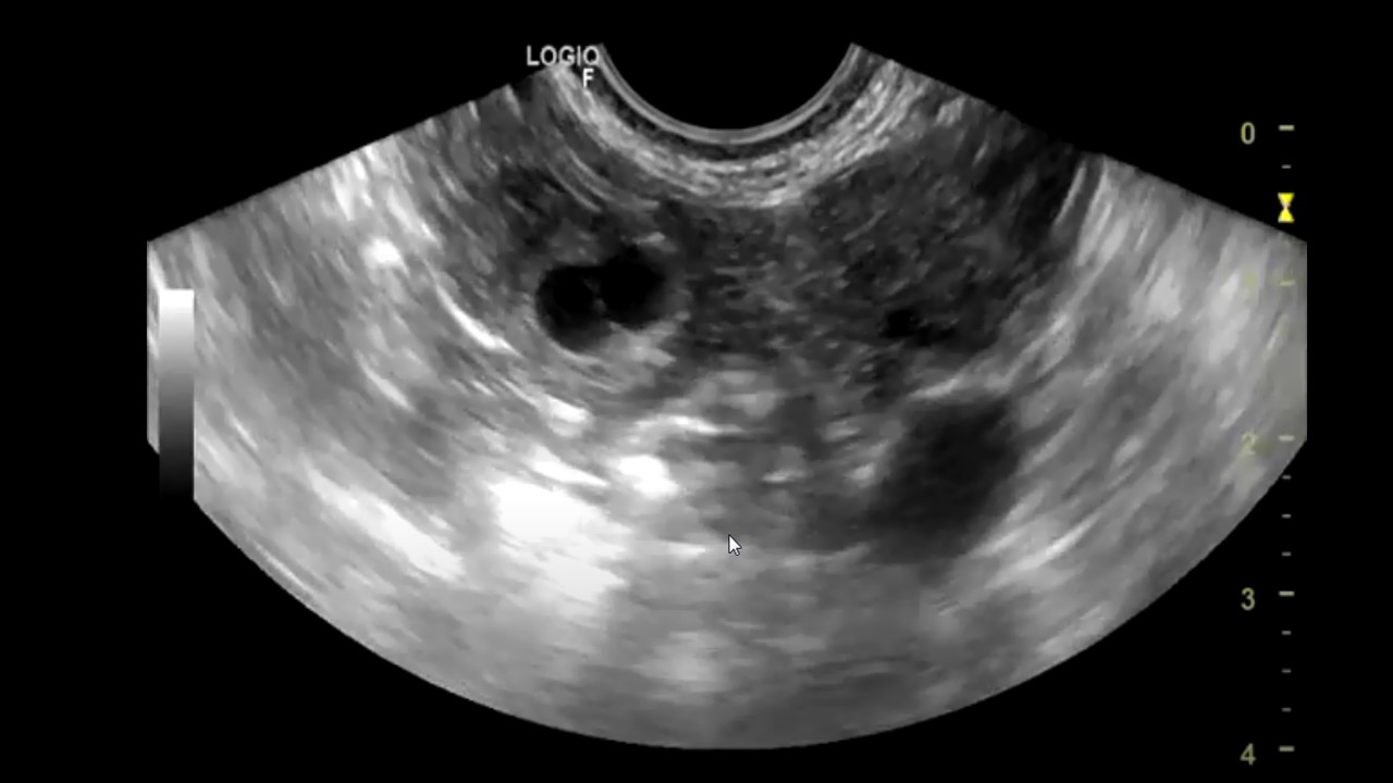 Риск внематочной беременности. Внематочная Трубная беременность. Внематочная беременность на УЗИ. Лапароскопия внематочная. Маточная беременность.