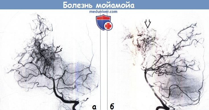 Окклюзия вса