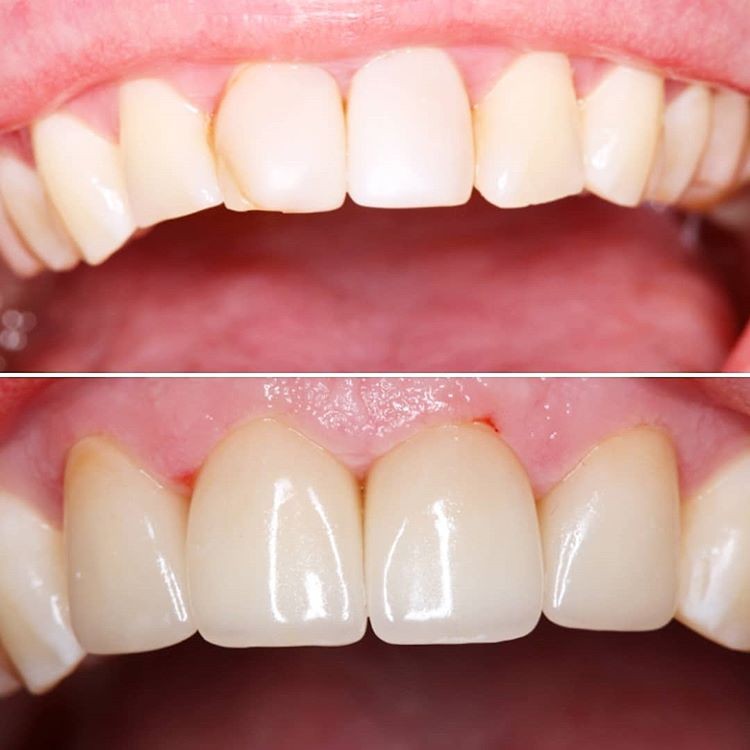 Зубная реставрация. Композитные виниры кариес. Восстановление передних зубов. Композитная пломба на передние зубы.