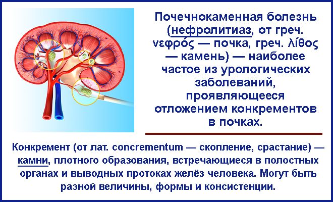 Нефролитиаз это. Нефролитиаз нефролитиаз. Почечнокаменная болезнь (нефролитиаз). Показатели для почечнокаменной болезни.