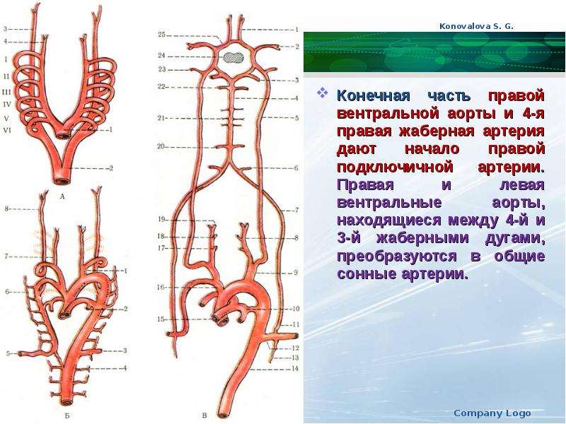 Трифуркация внутренней сонной артерии