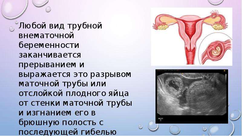 Тактика врача при внематочной беременности