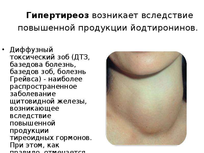 Щитовидная железа симптомы у мужчин внешние признаки. Тиреотоксикоз гиперфункция щитовидной железы. Гиперфункция щитовидной железы зоб. Гипертиреоз симптомы зоб. Зоб щитовидной железы токсический гиперфункция.