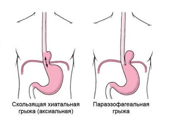 Грыжа пищевода симптомы и лечение у мужчин