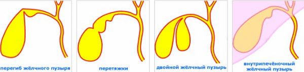 Желчный пузырь неправильной формы с перегибом