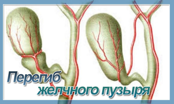 Желчный пузырь неправильной формы с перегибом