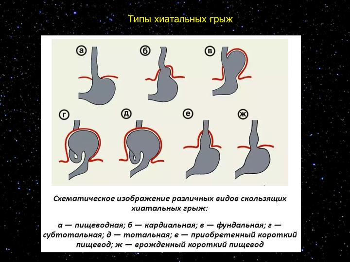 Диафрагмальные грыжи презентация хирургия