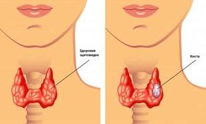 Как проявляется киста щитовидки