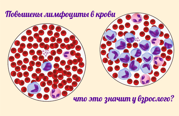 На фото пример повышенного уровня лимфоцитов в крови, при анализе в микроскоп.