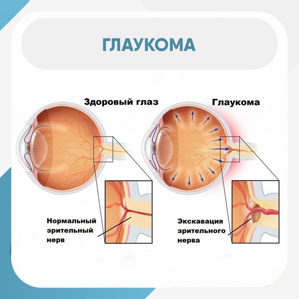Глаукома латынь. Стабилизированная глаукома. Глаукома глаза симптомы.