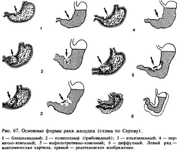 Ригидный антральный гастрит схема