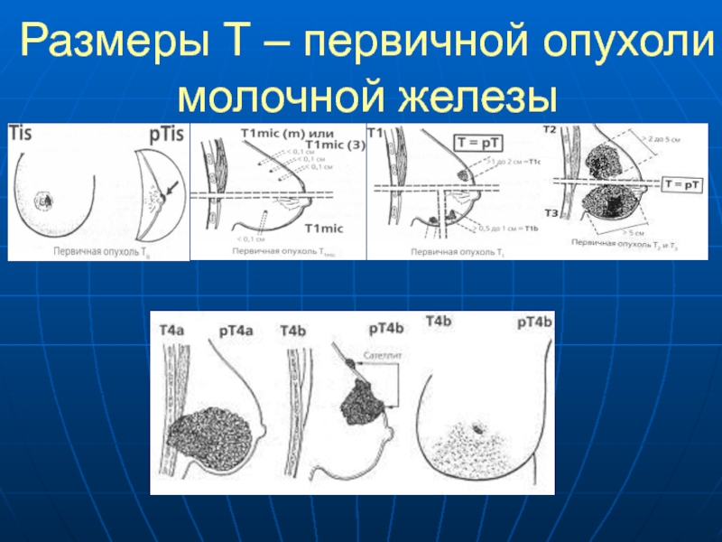 Размер раковой опухоли. Новообразование молочной железы. Злокачественное новообразование молочной железы. Размеры опухоли молочной железы. Диаметр молочной железы.