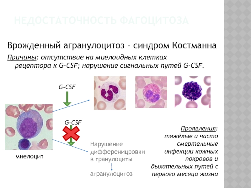 Клиническая картина агранулоцитоза