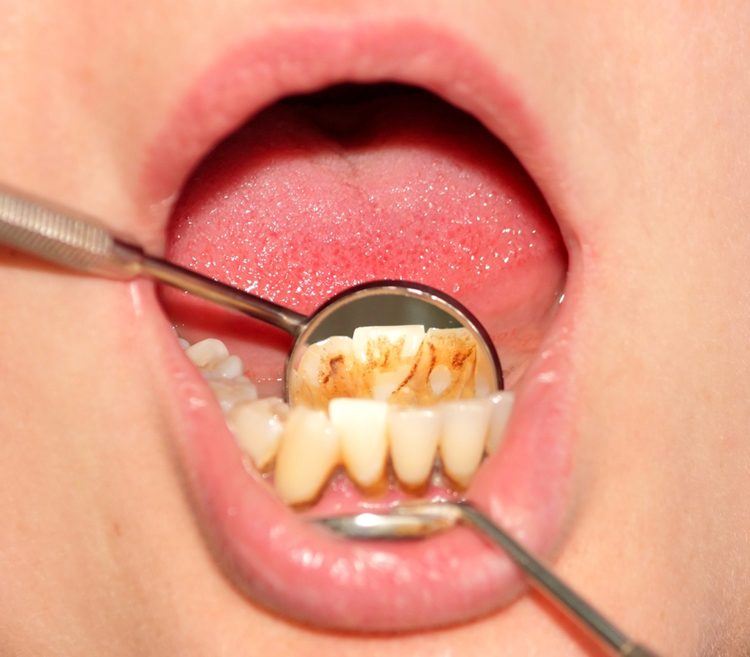Можно ли избавиться от зубного камня дома? Что говорят стоматологи